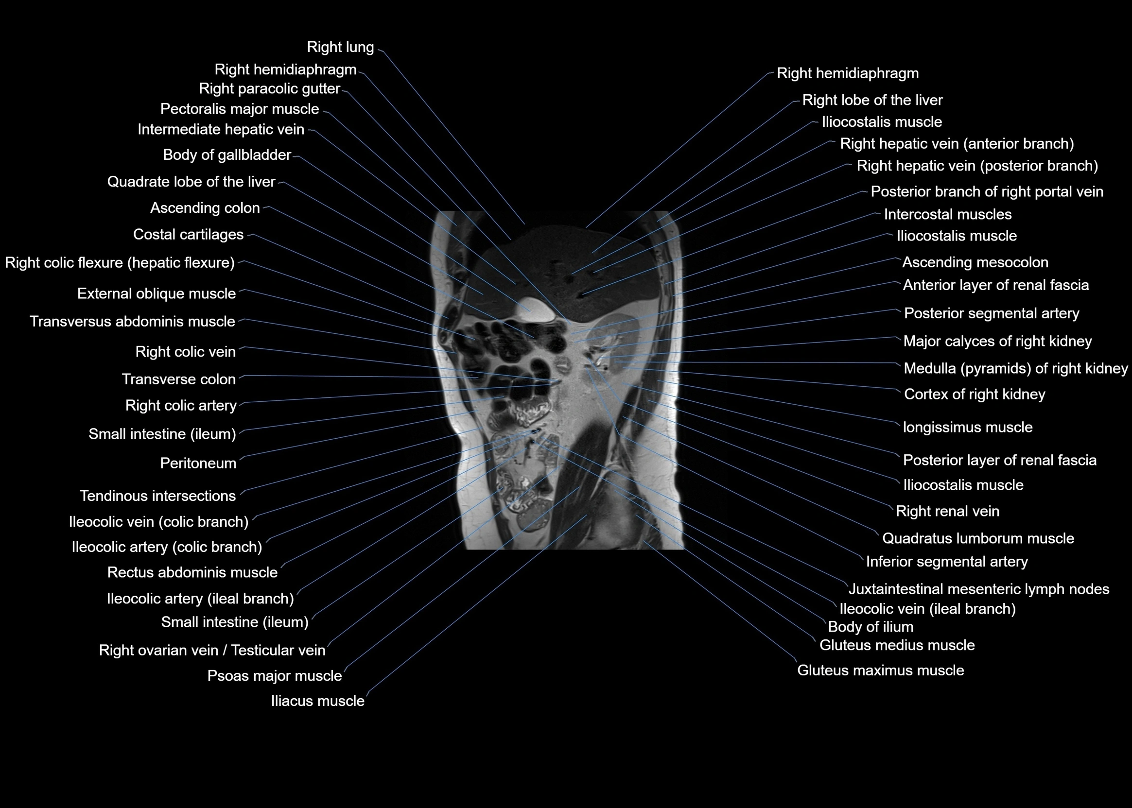 MRI abdomen sagittal cross sectional anatomy  radiology  image-img-00001-00025.webp